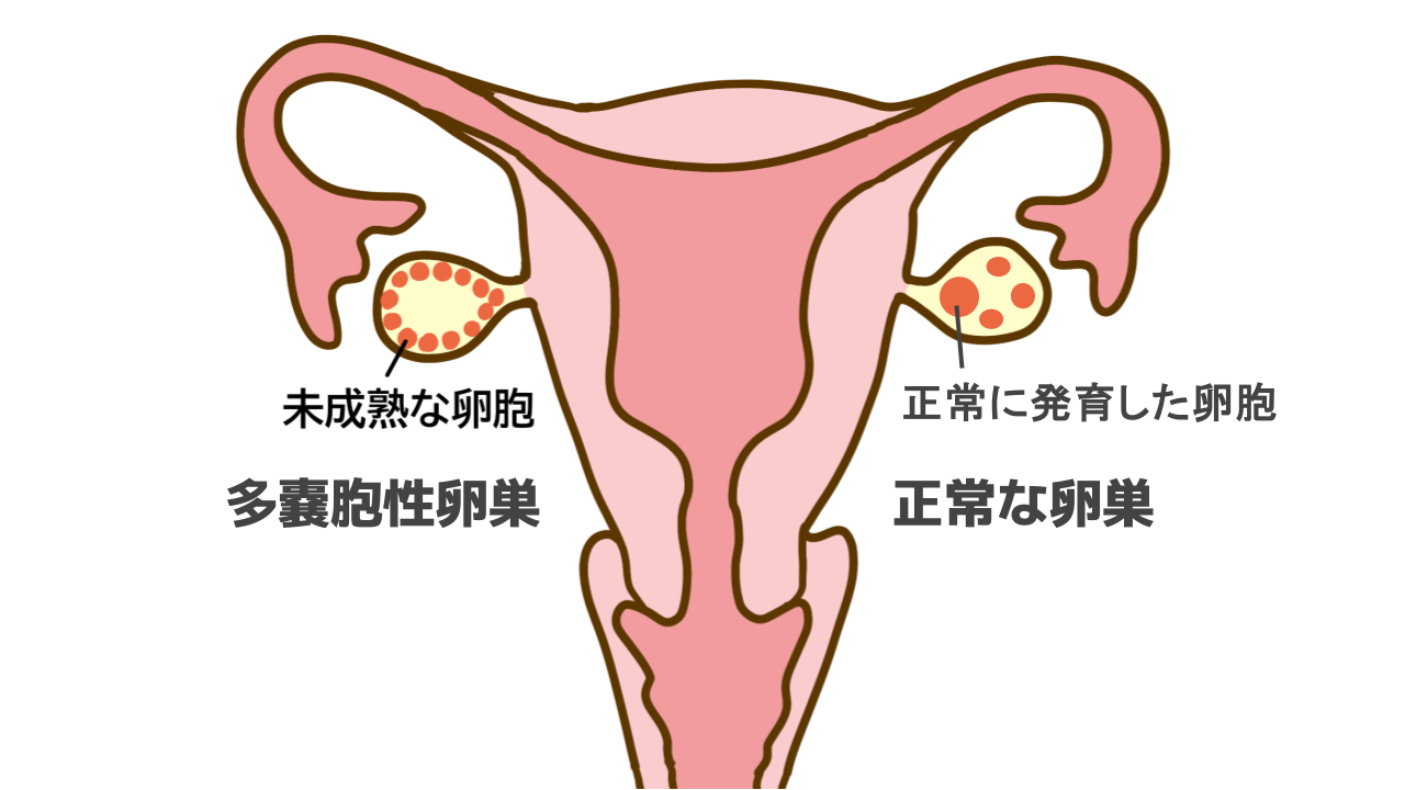 多嚢胞性卵巣