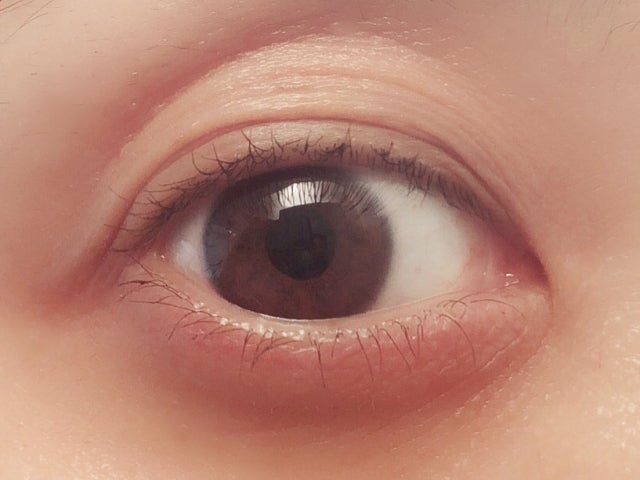 他の目の病気