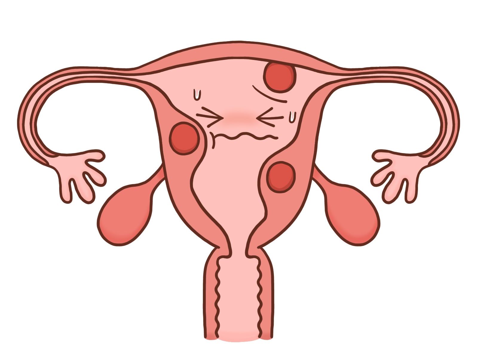 子宮筋腫がある子宮のイラスト