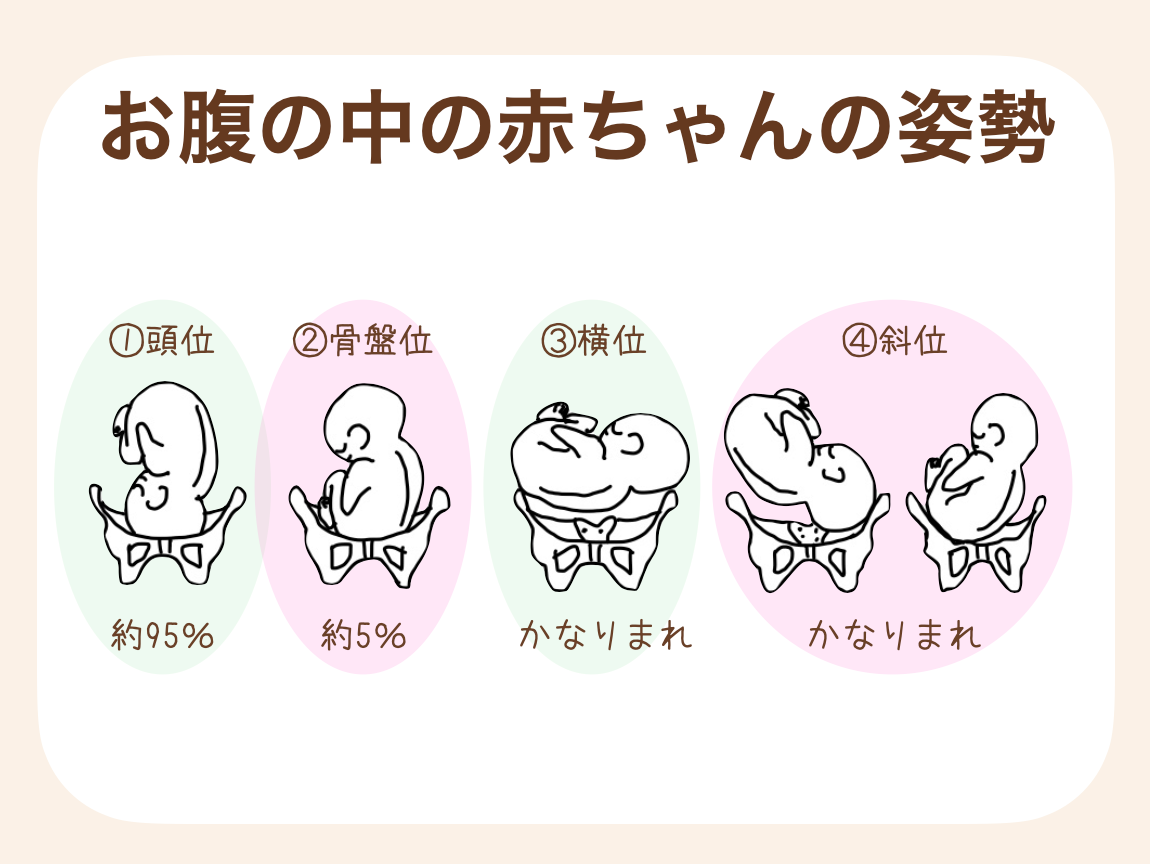 お腹の中の赤ちゃんの姿勢は、大きく4種類