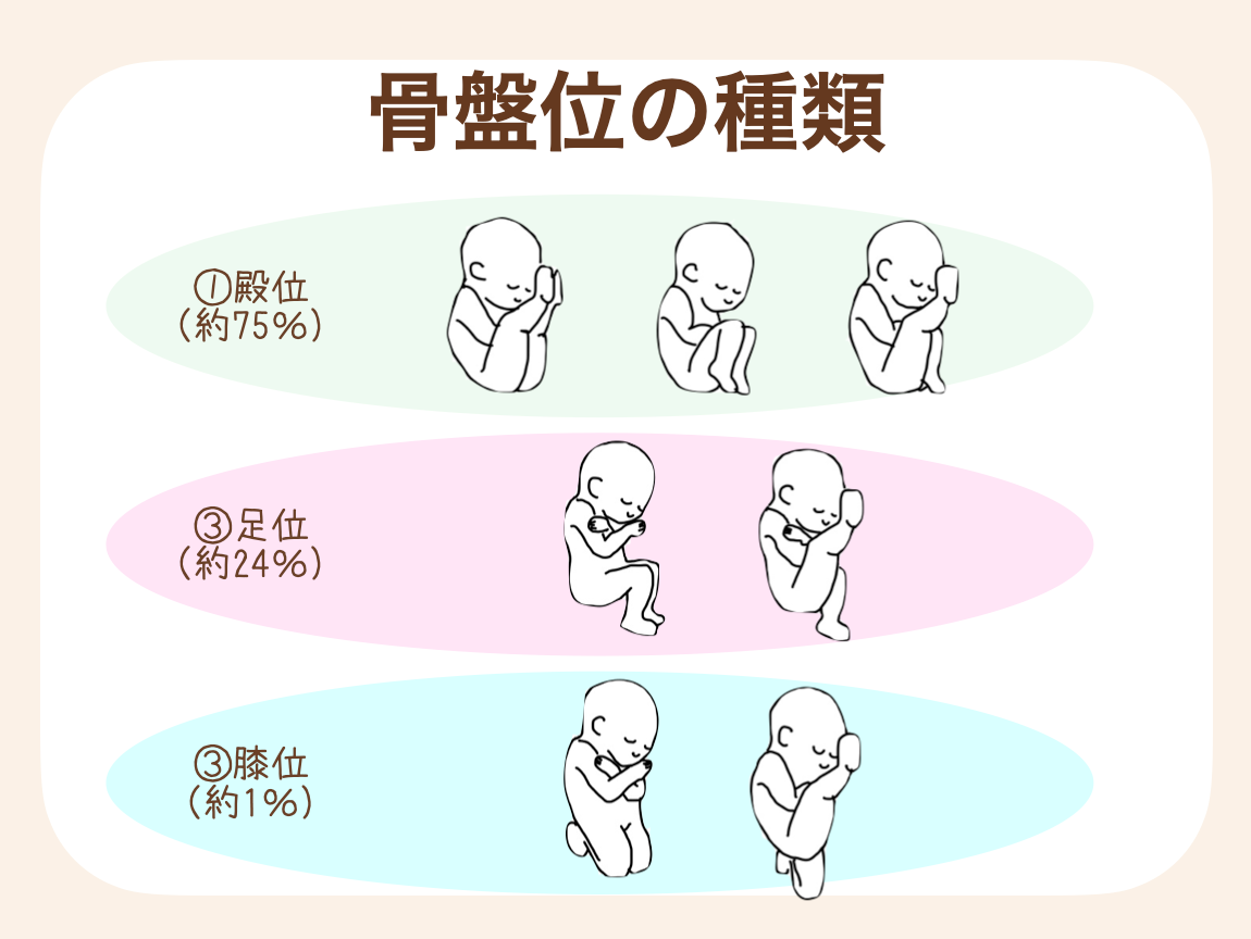「骨盤位」と一言で言っても、実は骨盤位にも種類がある。