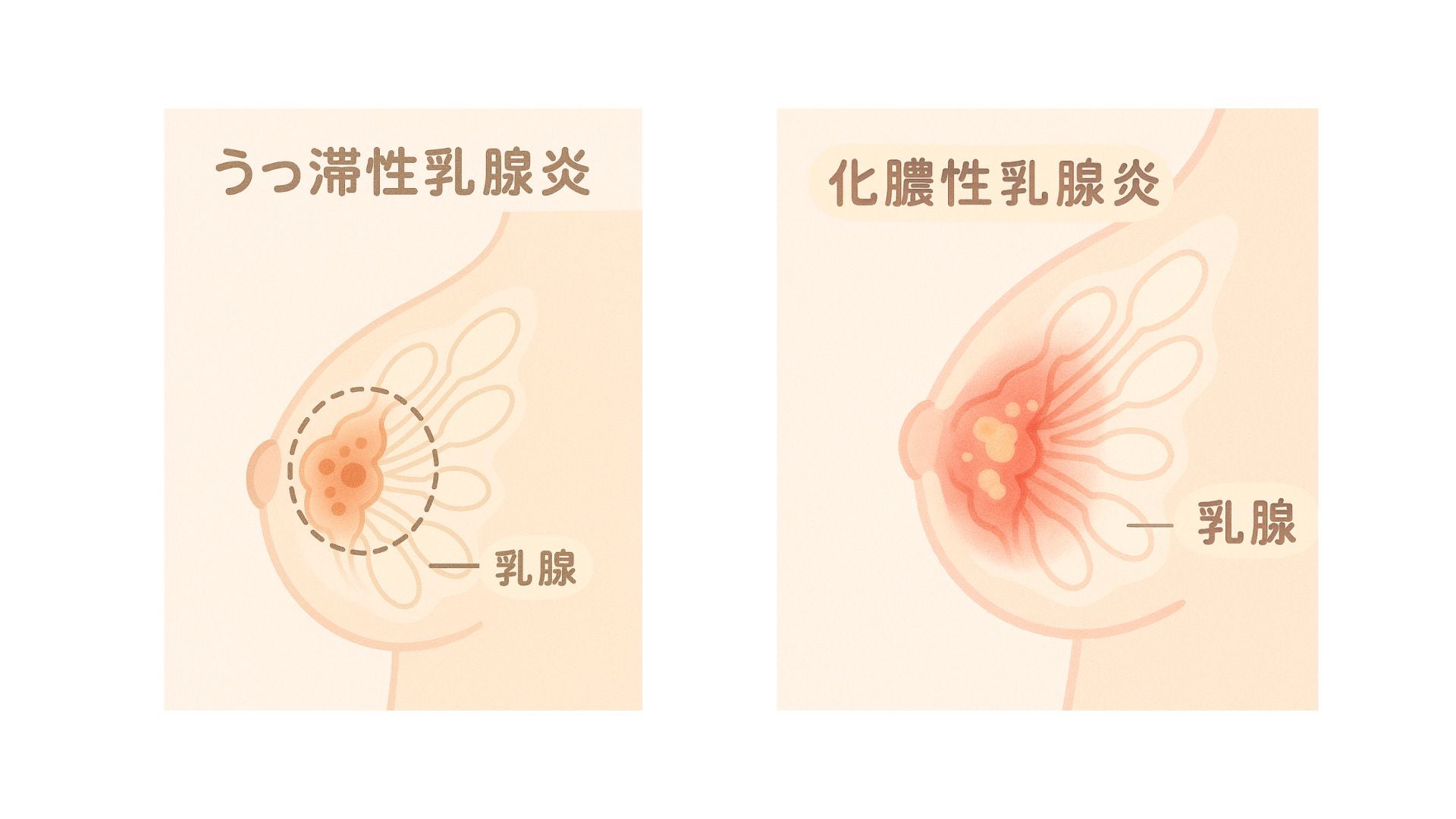 乳腺炎はよくあるおっぱいトラブルのうちのひとつです。乳腺炎には2つの種類があります