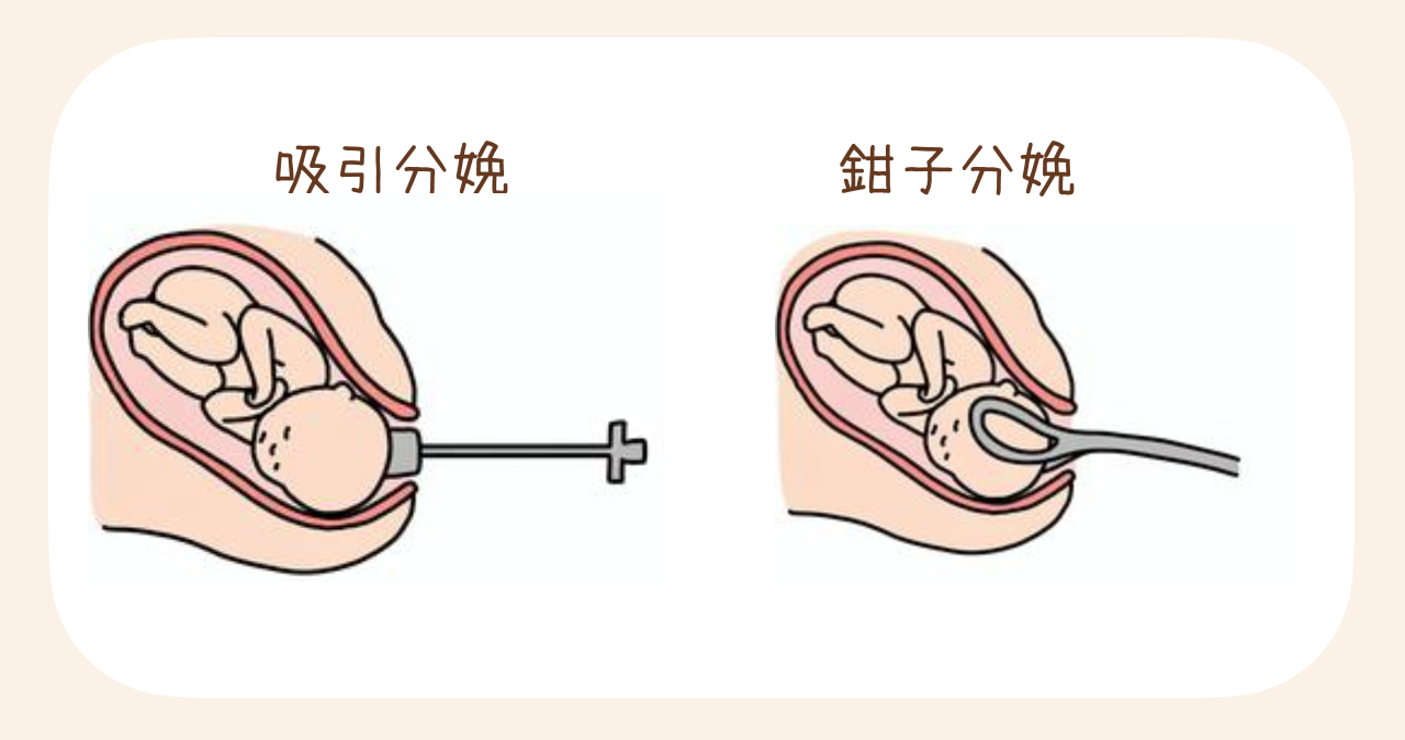 経膣分娩の中でも、特別な医療器具を使って出産する方法を「器械分娩（きかいぶんべん）」といいます。
