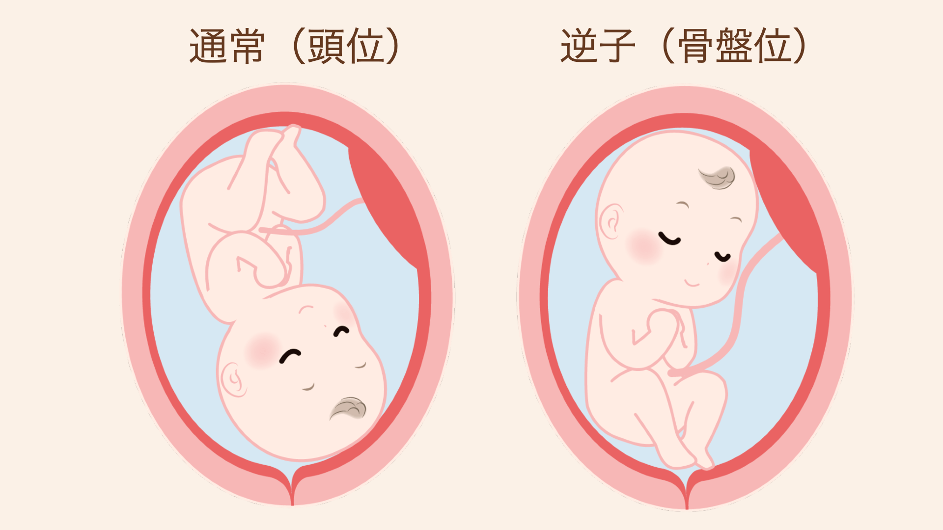逆子とは、赤ちゃんがおなかの中で頭を上にした状態のこと。通常の「頭位」は頭を下にした状態です