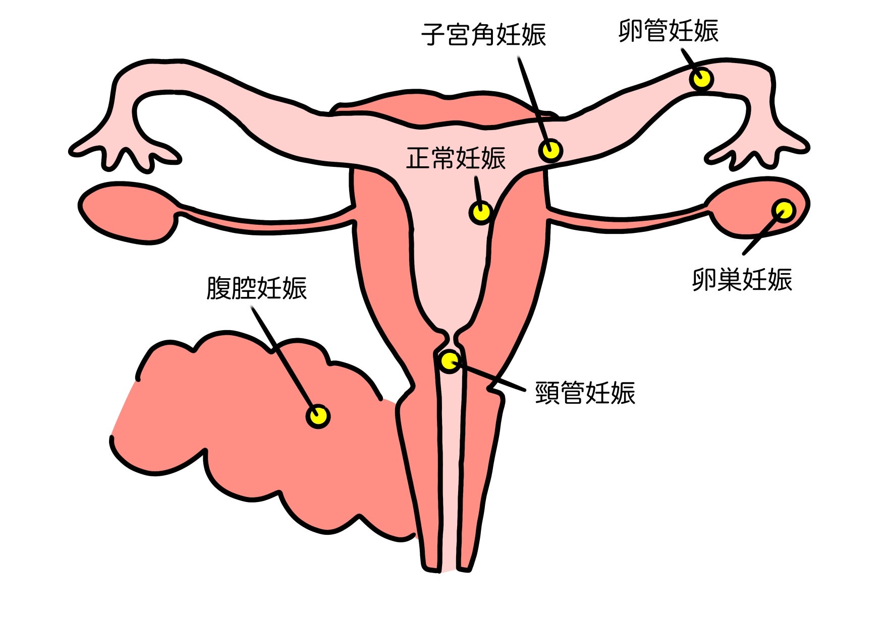 子宮外妊娠とは、受精卵が子宮の中ではなく、卵管など子宮以外の場所に着床してしまうことをいい、医学用語では「異所性妊娠」と呼ばれます。