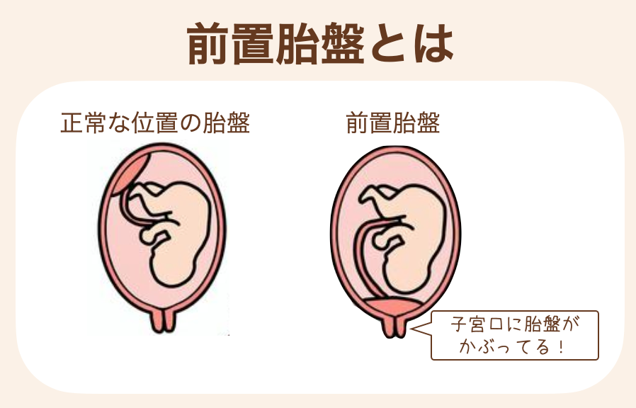 胎盤が子宮口にかぶっている状態