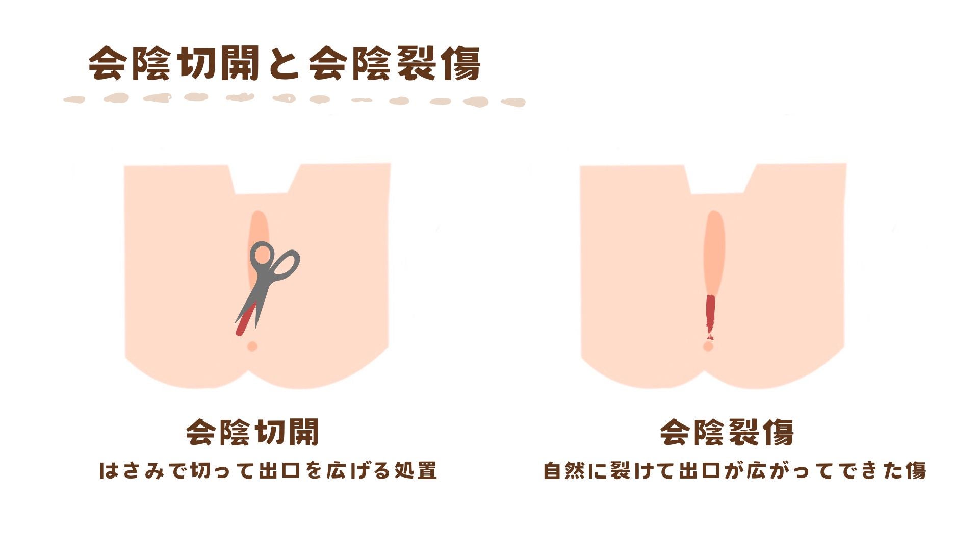会陰切開と会陰裂傷の違いについて紹介します