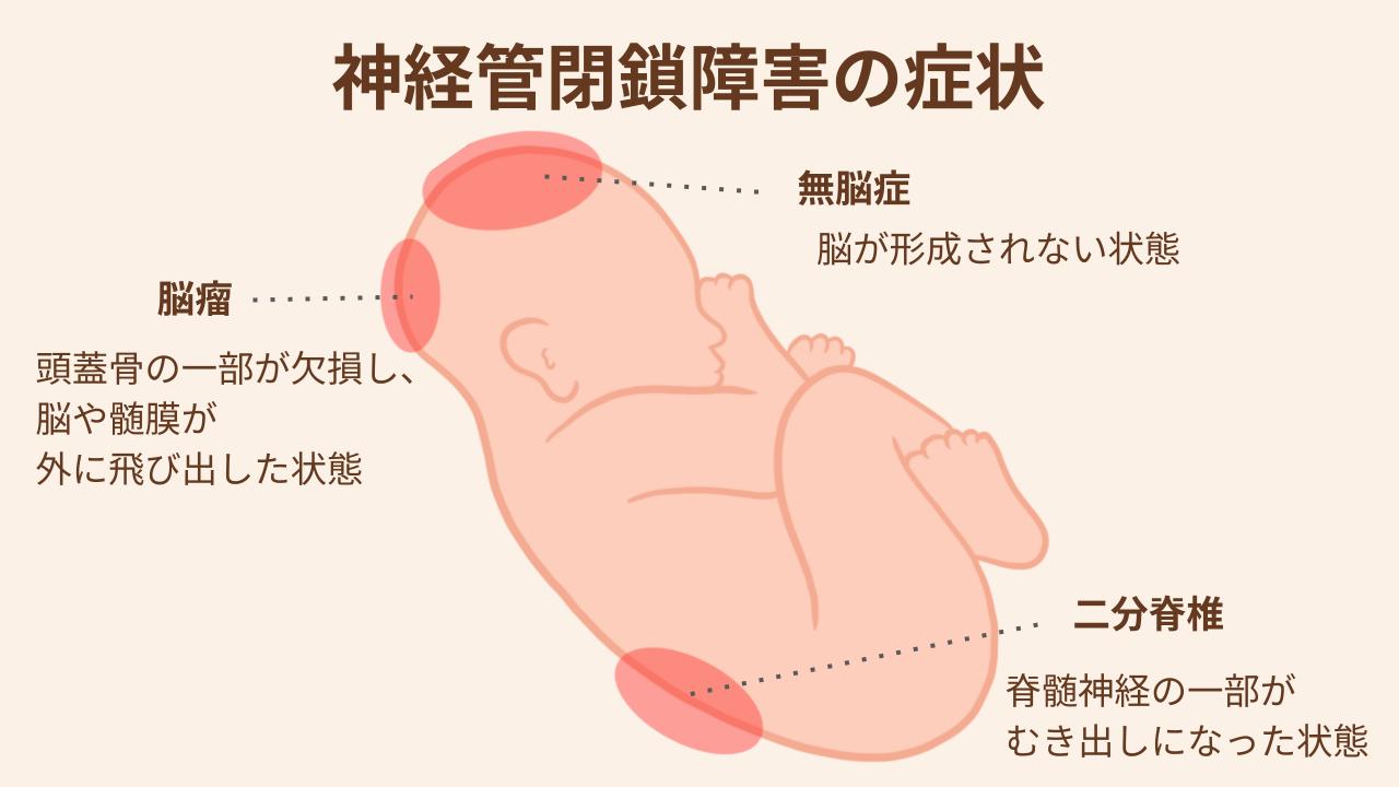 神経管閉鎖障害でよくみられる症状を解説