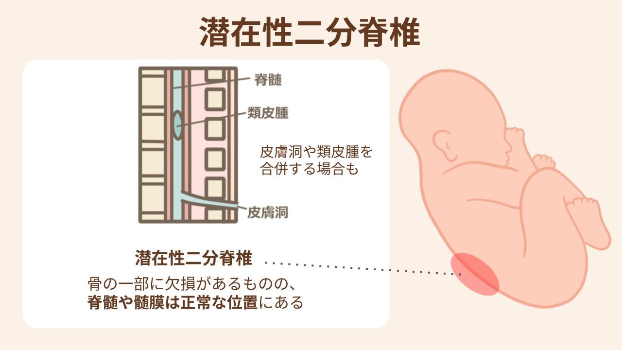 潜在性二分脊椎の症状と治療法を紹介