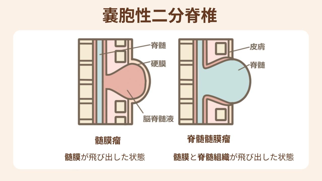 嚢胞性二分脊椎の症状と治療法を紹介
