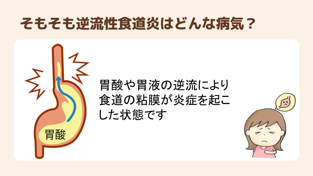 逆流性食道炎とは、胃酸や胃液が逆流し食道の粘膜が炎症を引き起こす病気
