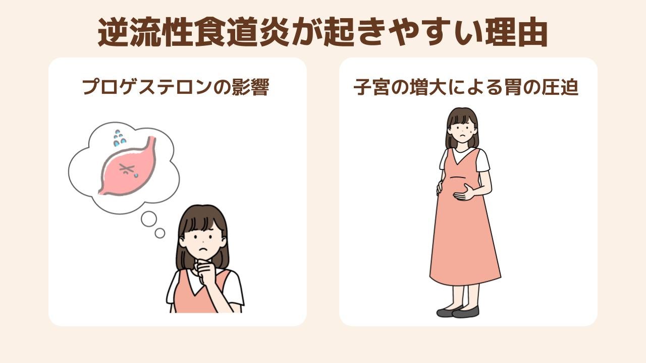 妊婦さんに逆流性食道炎が起きやすい理由