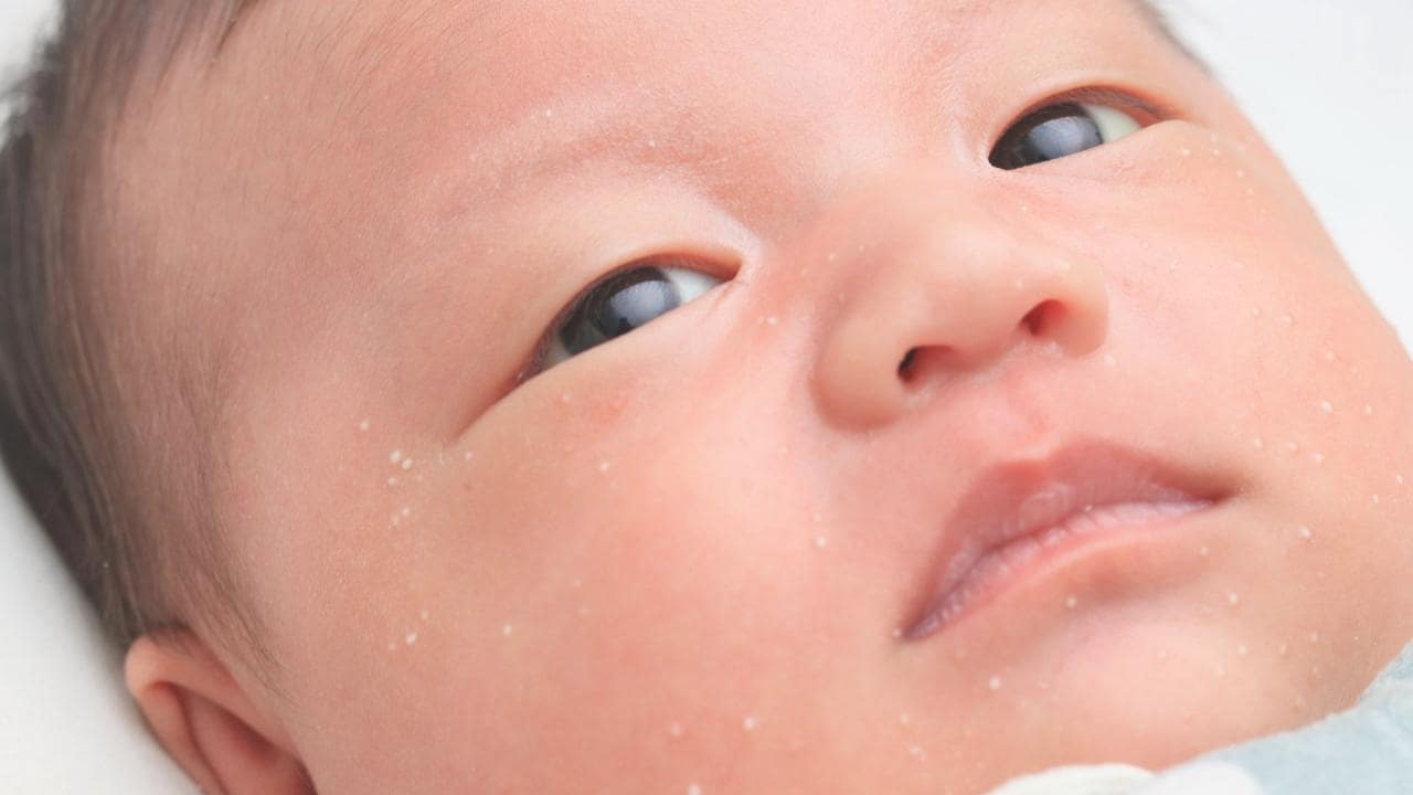 赤いポツポツや白い芯のある「赤ちゃんニキビ」