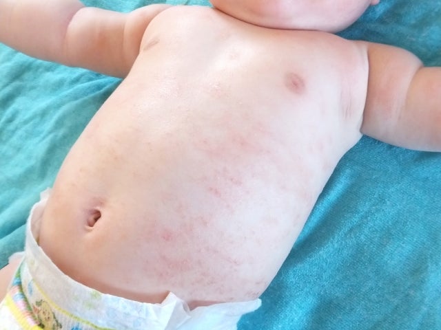 そもそも乳児湿疹って?:乳児湿疹の主な種類