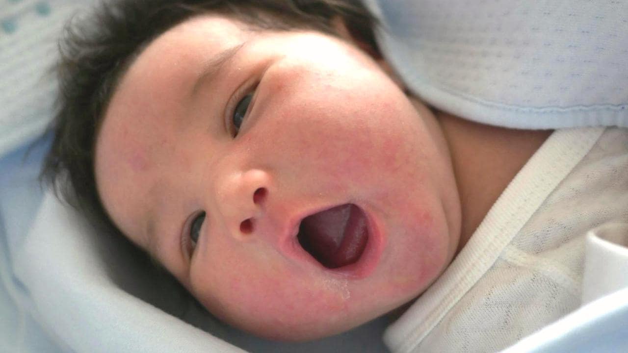 赤いポツポツや白い芯のあるニキビのような湿疹。いわゆる「赤ちゃんニキビ」。男の子にやや多い傾向がある