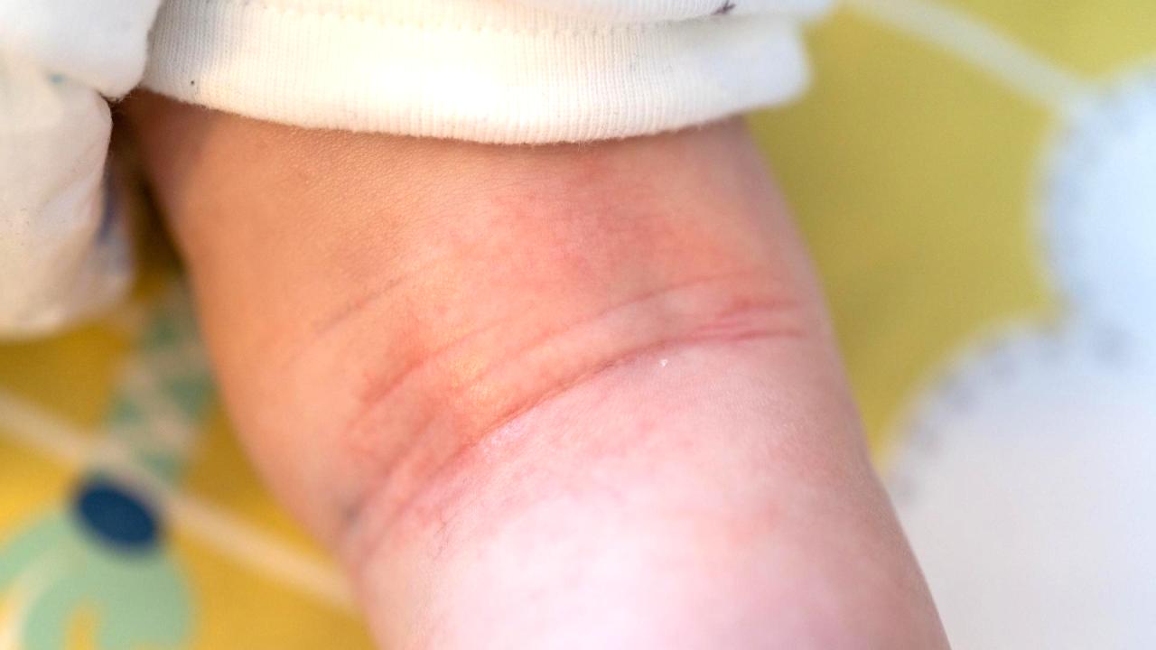 小さな赤いポツポツ（紅色汗疹）や、透明な水ぶくれのようなポツポツ（水晶様汗疹）。かゆみを伴うことも