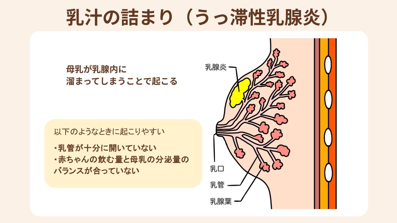 うっ滞性乳腺炎は、母乳が乳腺内にたまってしまうことで起こる