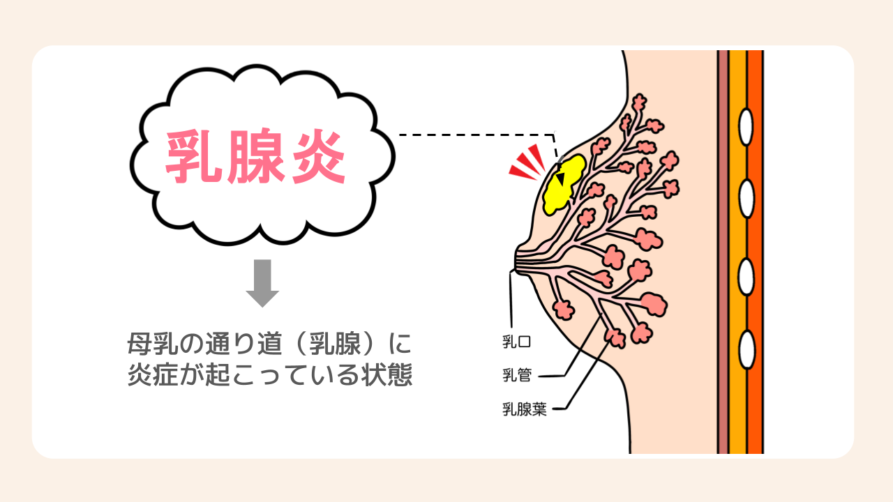 乳腺炎が起こる仕組み