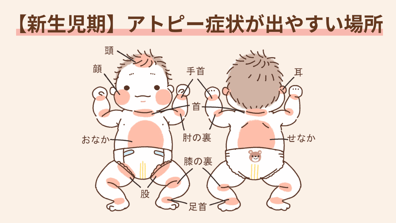 皮脂の分泌が多い顔、頭、耳の周りから始まり、次第に首、肘や膝のくぼみ、手首や足首など、関節部分に広がっていく