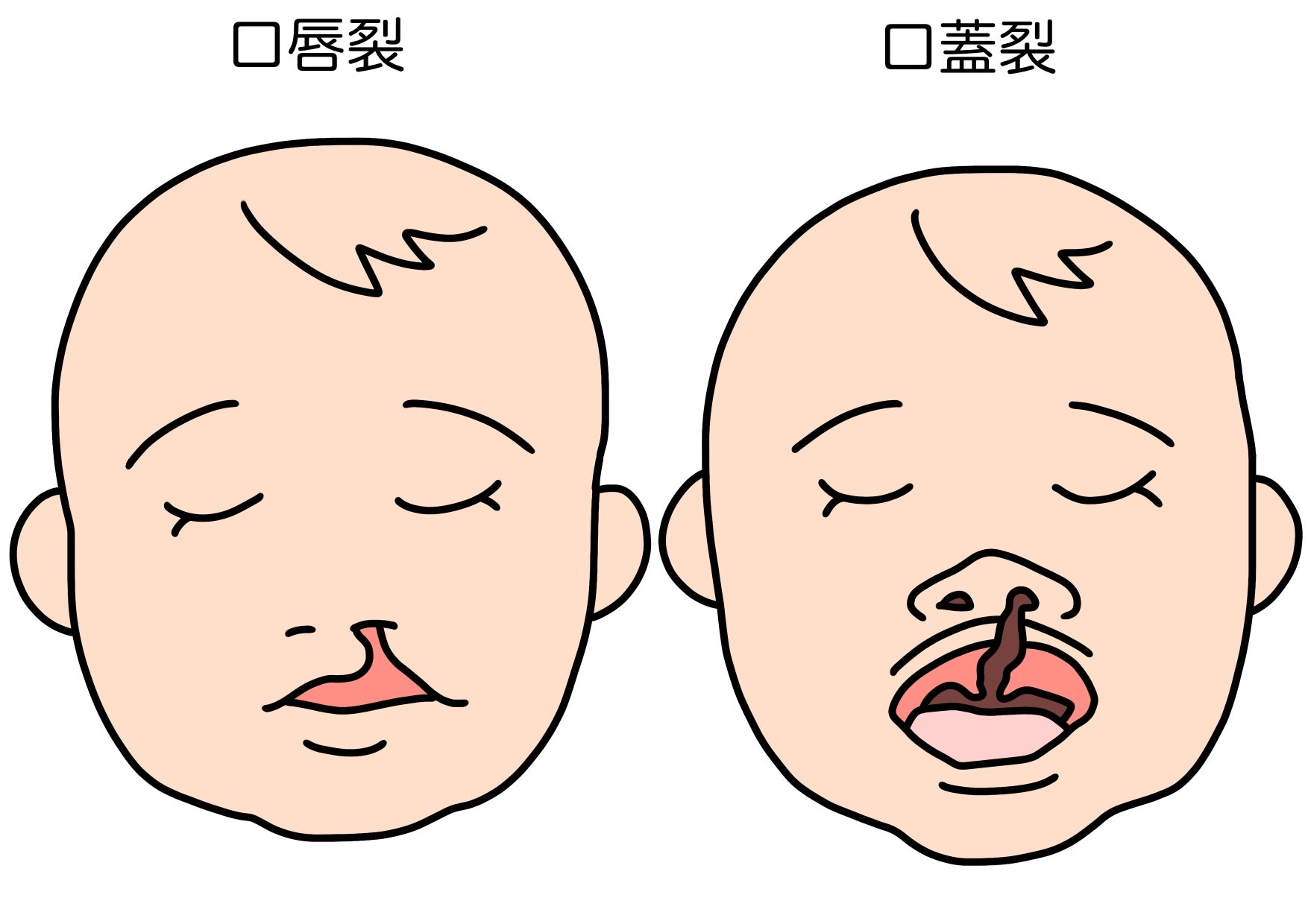 口唇裂・口蓋裂とは、器官形成期に組織の欠損や融合不全によって、口唇や口蓋（口の中の天井の部分）などに割れ目が残ってしまったもので、赤ちゃんの先天性異常のひとつ