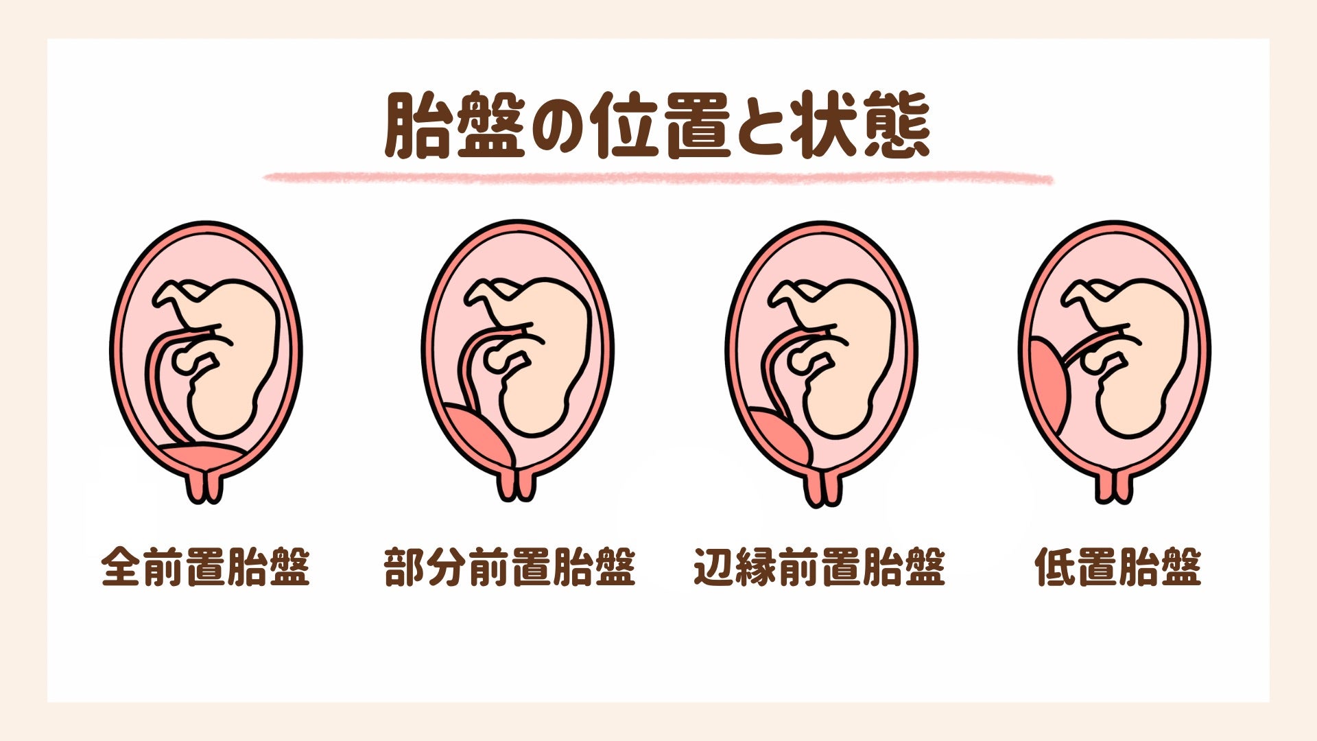 前置胎盤について解説