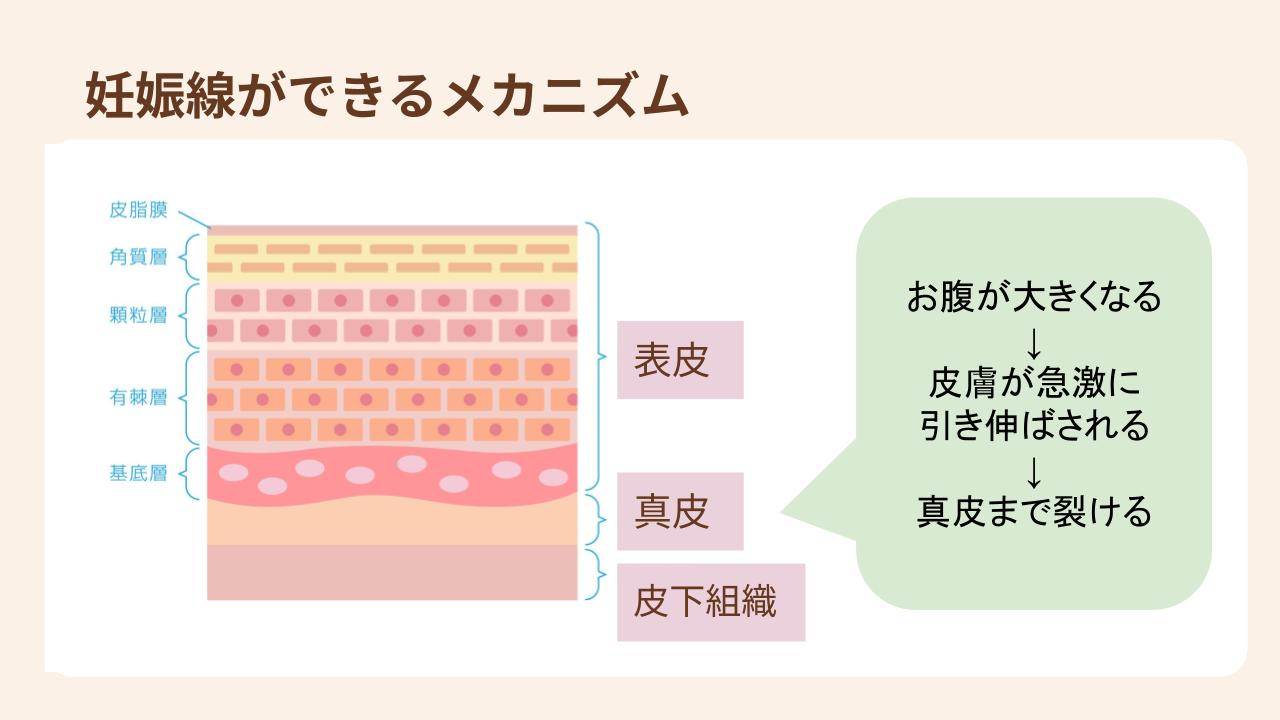 真皮まで裂けることで妊娠線ができる