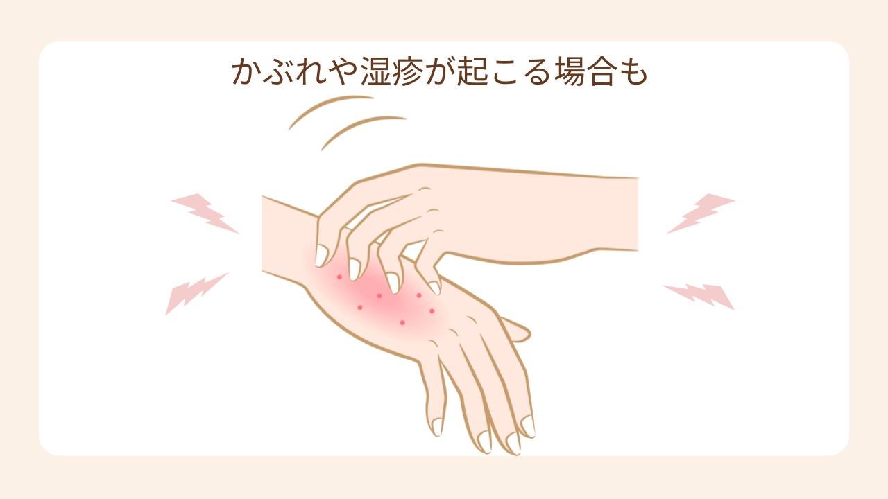 肌が敏感な妊娠中はかぶれや湿疹が起こることもある