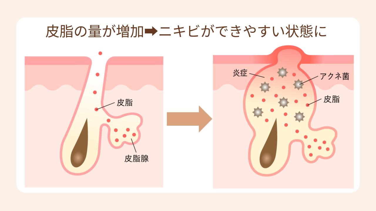 妊娠中は皮脂分泌が増加し、ニキビや吹き出物ができやすい