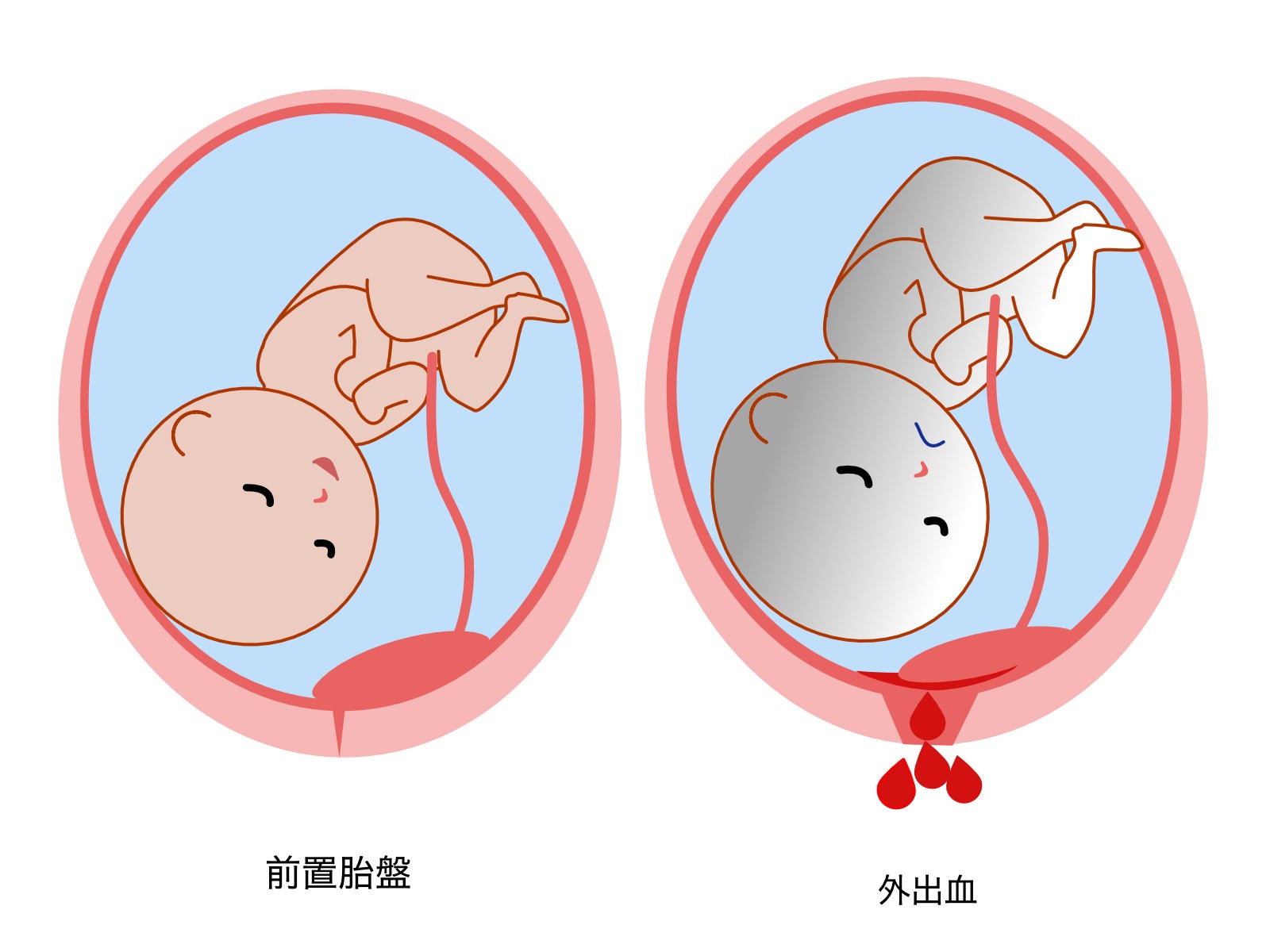 前置胎盤と診断された方は出血に特に注意が必要