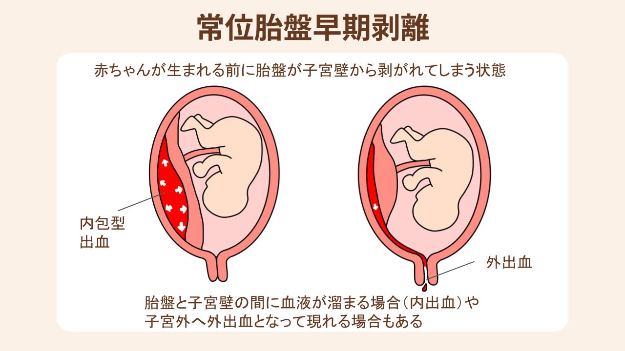 常位胎盤早期剥離の症状