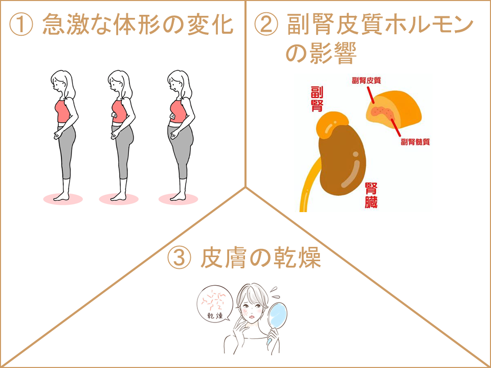妊娠線を消す方法