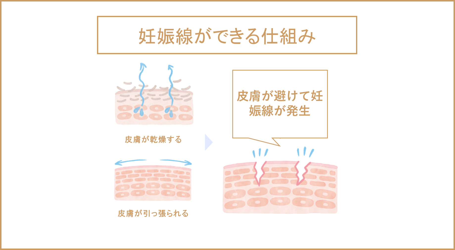 妊娠線ができる仕組みについてのイラスト