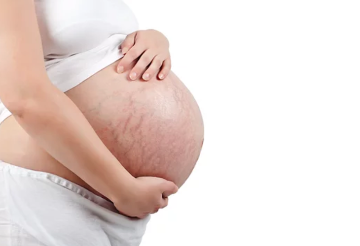 妊娠線ができやすい時期は妊娠8ヶ月以降