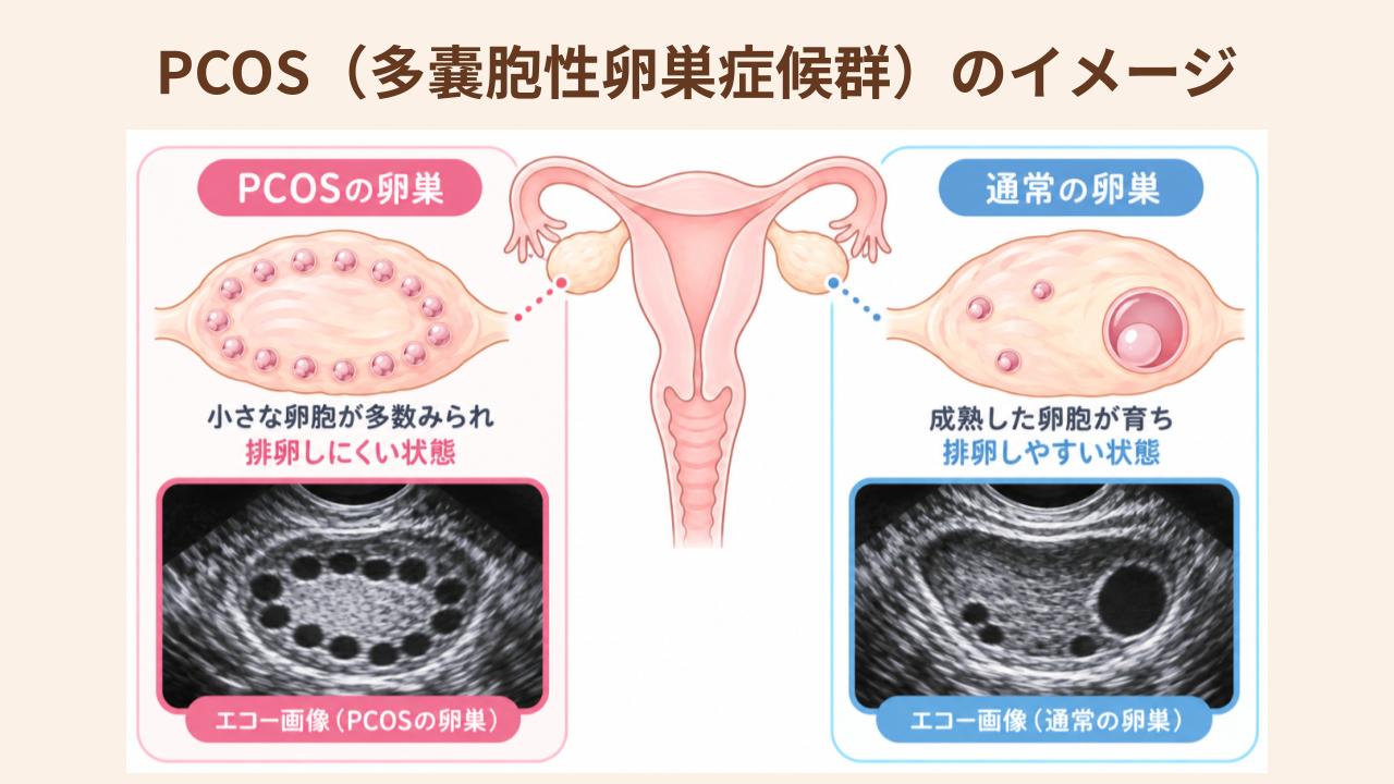 PCOSでは小さな卵胞が多数みられる「ネックレスサイン」
